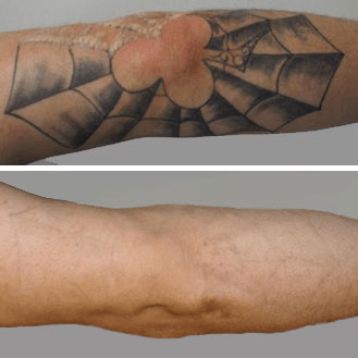 Laser Tattoo Removal Elbow Before After